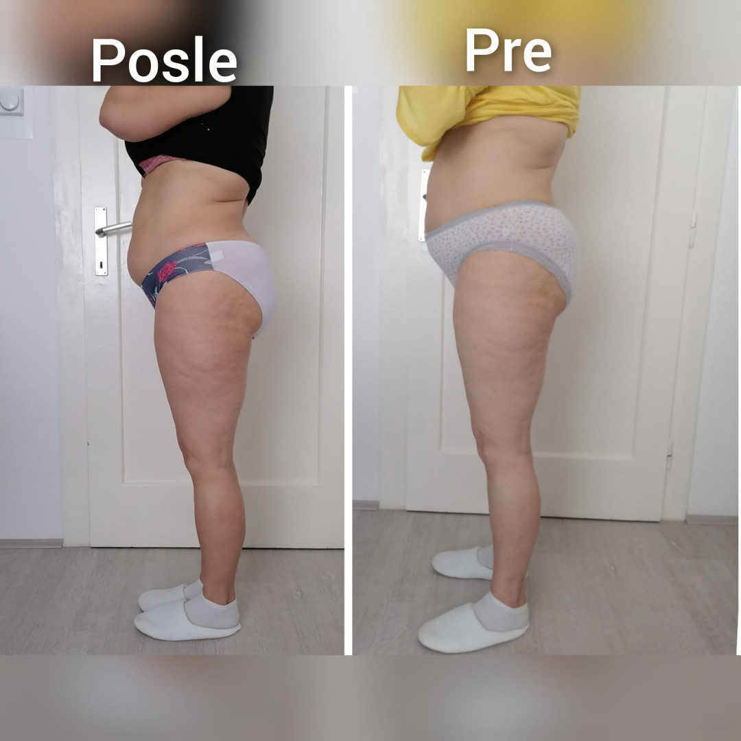 Skinlift Beauty Centar #nis Masaža za mršavljenje 6 tretmana kavitacije + 6 RF tretmana + 12 tretmana presoterapije