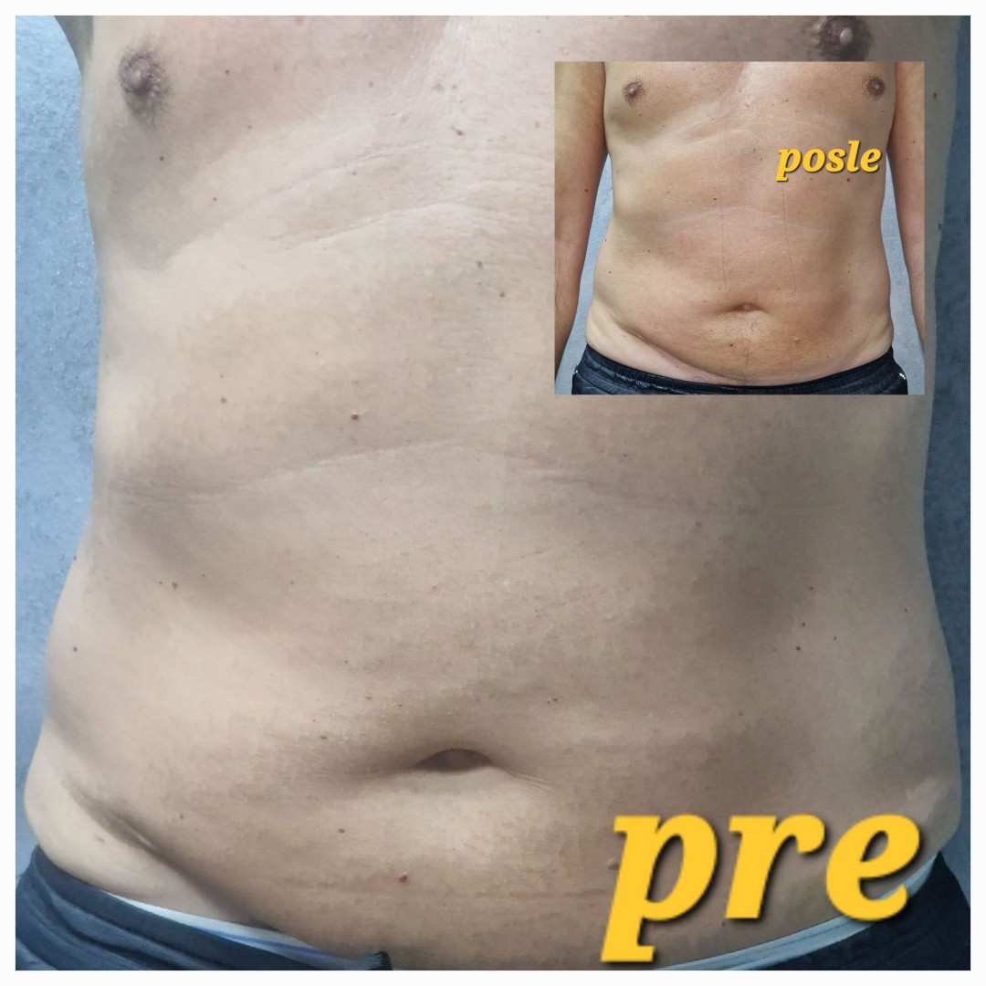 Seaside beauty #beograd Tretmani za mršavljenje Slimming sistem 4 u 1 - 5 tretmana