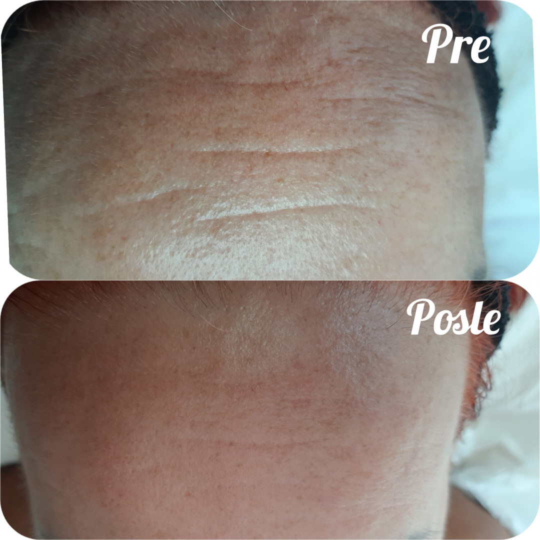Elin Sary Mary Kutak #beograd Medicinski pedikir Derma Fix tretman lica sa kolagenskim nitima - paket od 3 tetmana