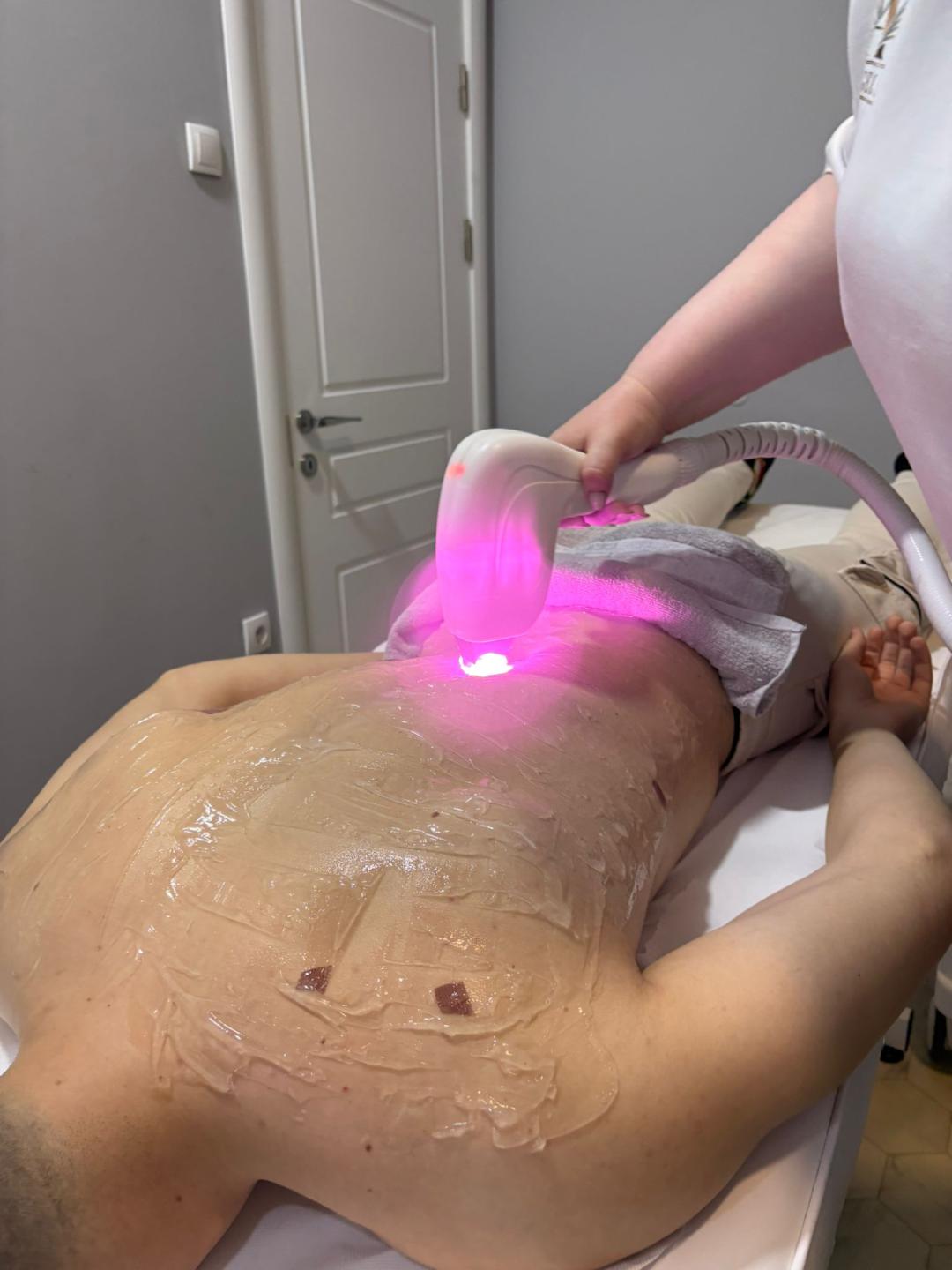 Angels #novisad Laserska epilacija Laserska epilacija leđa - za muškarce