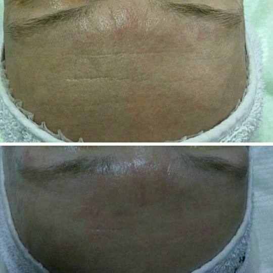 Look at me #beograd Tretmani protiv bora 3D Wrinkle tretman lica Nakon drugog tretmana