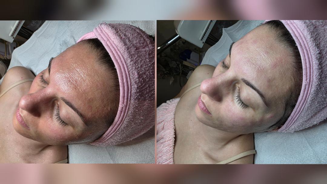 Klasičan tretman lica - Starmedic, Beograd Tretman lica Lice Tretman lica, Beograd, Vračar, Čubura, Crveni krst