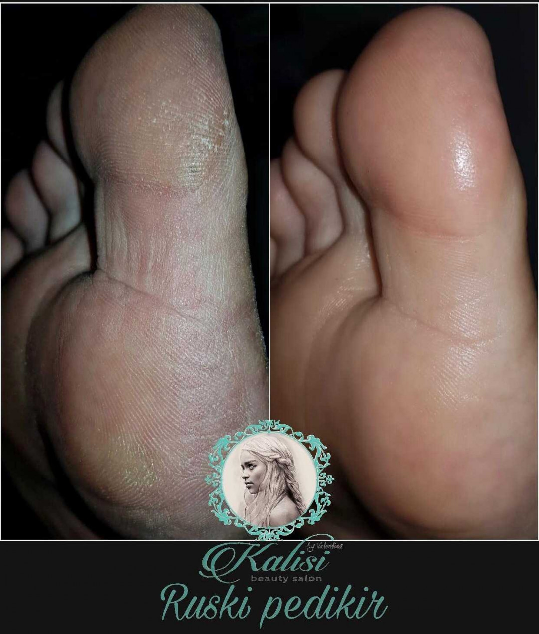Kalisi #beograd Estetski pedikir Aparatni pedikir