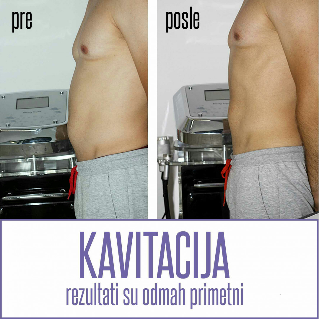 Chic & Unique #beograd Kavitacija