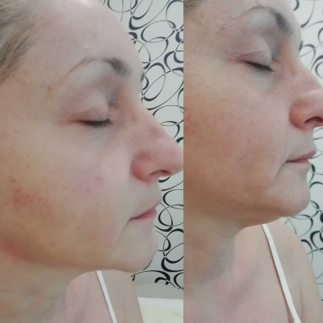 Olja Beauty #beograd Lifting / zatezanje kože HiFu tretman lica - po regiji