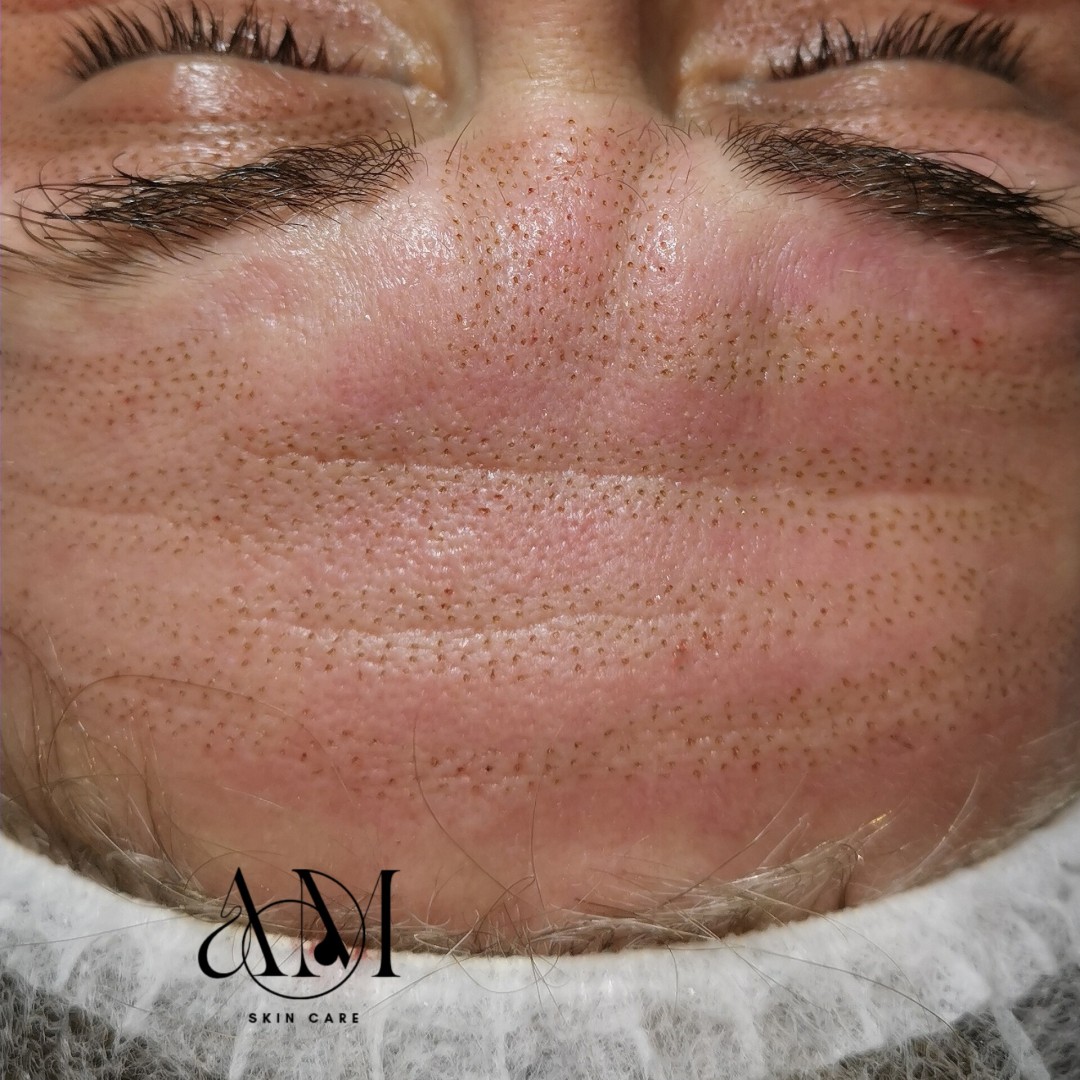 AM BEAUTY STUDIO #odzaci Radiotalasni i ultrazvučni tretmani Plasma pen - čelo
