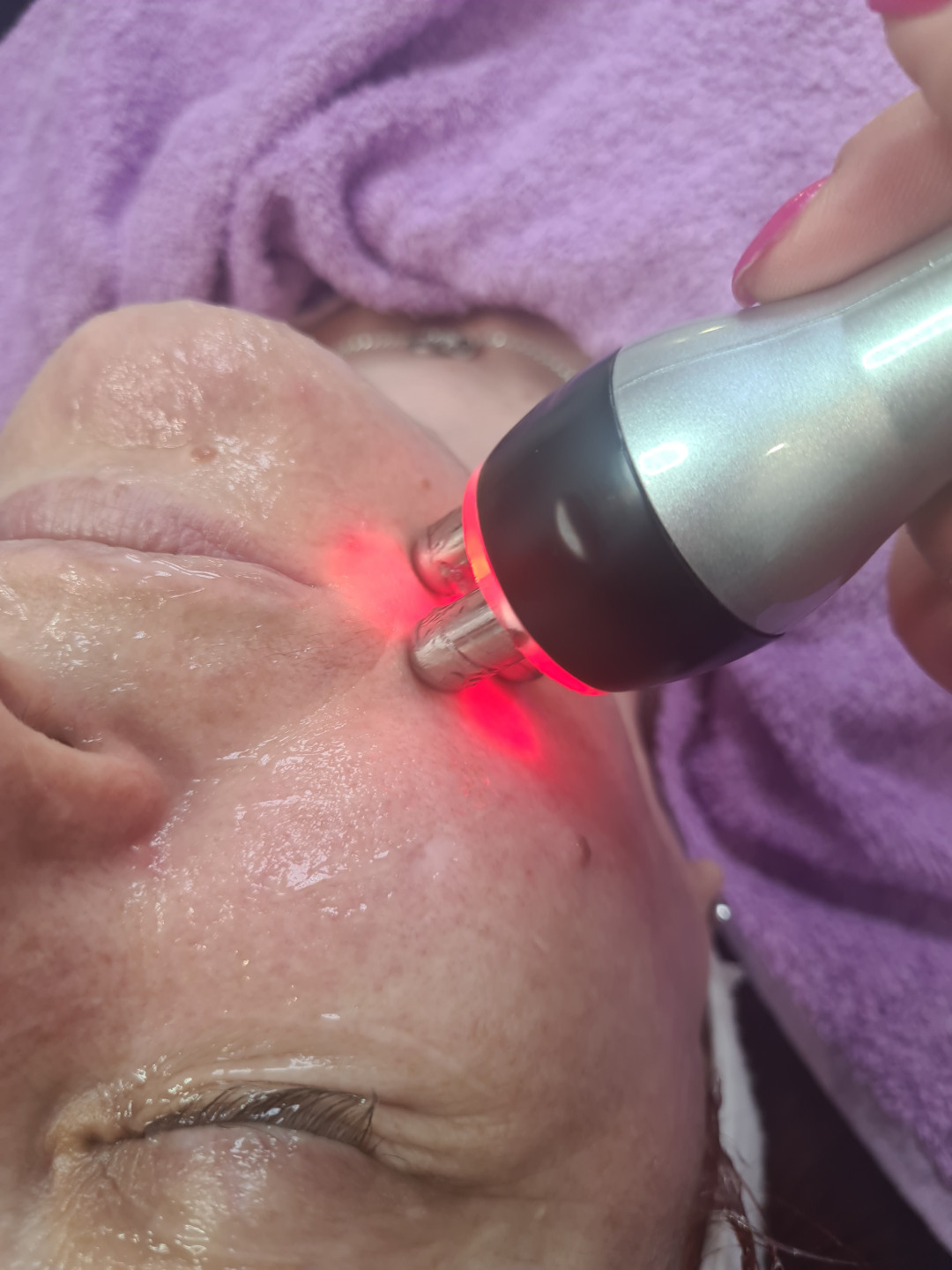 Laser centar Delight #beograd Laserski tretmani lica Lasersko podmlađivanje lica