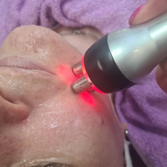 Laser centar Delight #beograd Laserski tretmani lica Lasersko podmlađivanje lica Lasersko podmladji