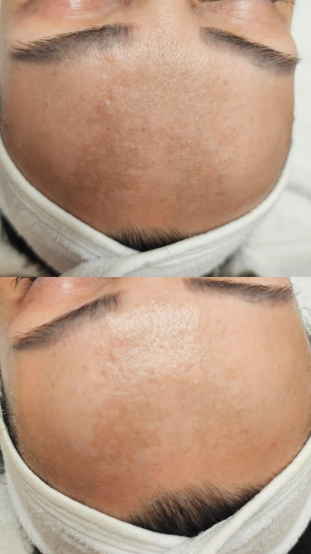 Choco Love #beograd Tretman lica Tretman lica egzozomima