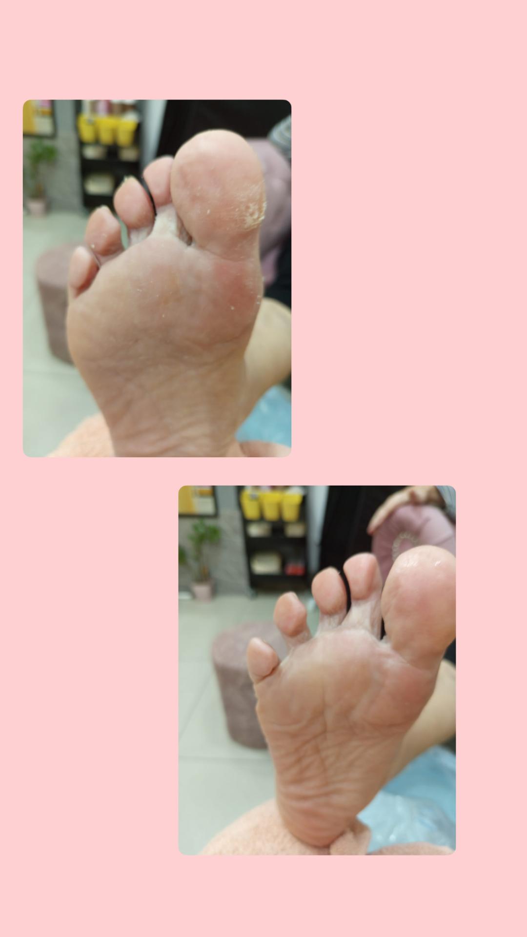 Mira 11 #beograd Medicinski pedikir Medicinski pedikir