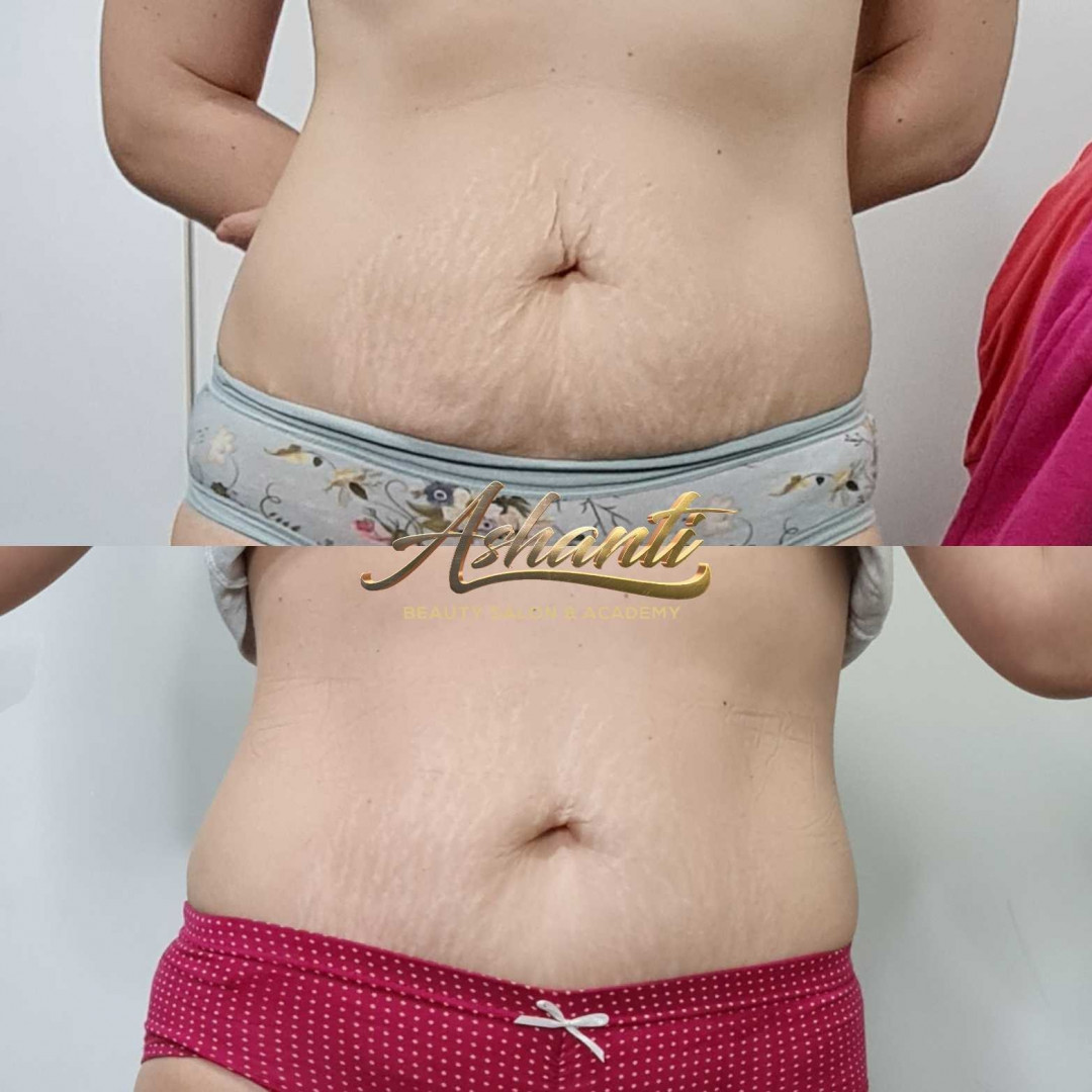 Ashanti Beauty Salon & Academy #beograd Masaža za mršavljenje Premium Maderoterapija - paket od 5 tretmana