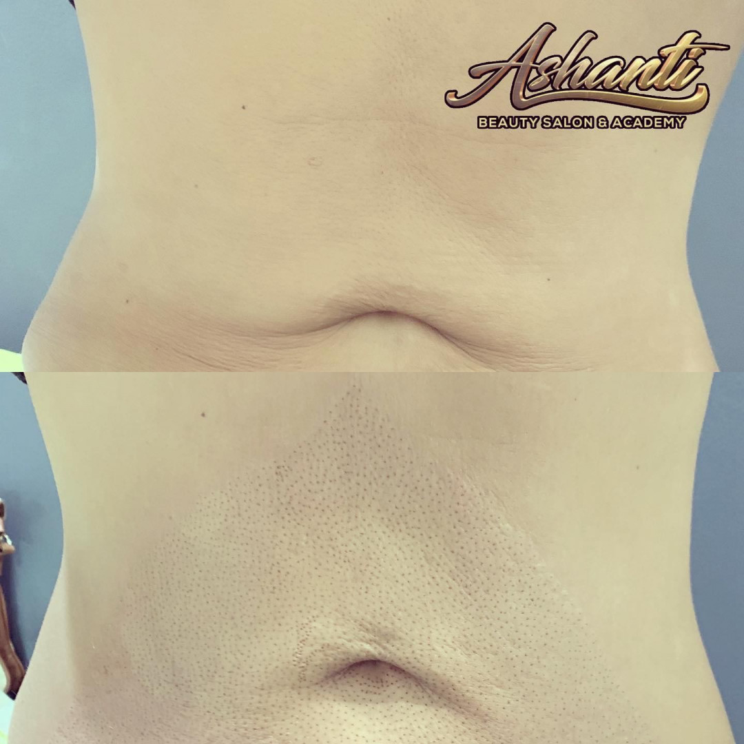Plasma pen - stomak - Ashanti Beauty Salon & Academy, Beograd Tretman lica Lice Tretman lica, Beograd, Voždovac