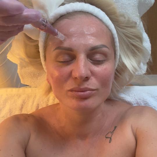 Glow Holistic Studio #beograd Dermaroler i dermapen Dermapen - lice + vrat + dekolte Ovaj tretman po
