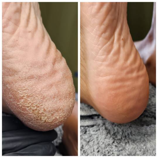 Mango beauty studio #novisad Estetski pedikir Kalus pedikir Kalus pedikir je specijalizovan tretman 