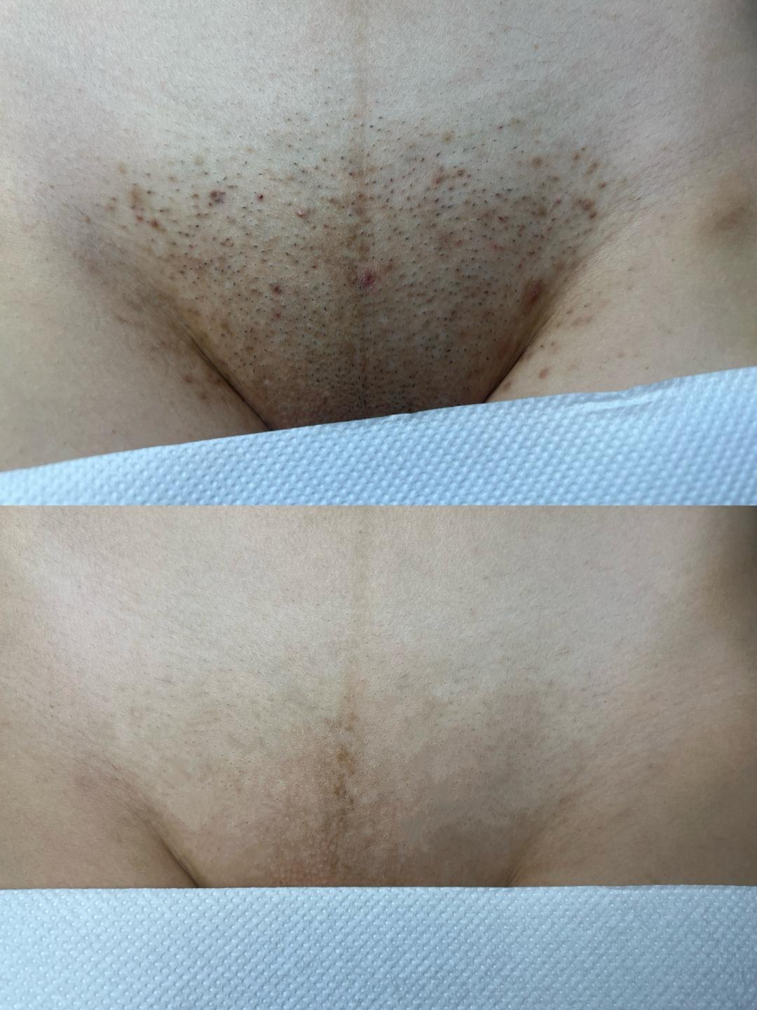 Maison de mi #beograd Laserska epilacija Brazilska laserska epilacija - za dame