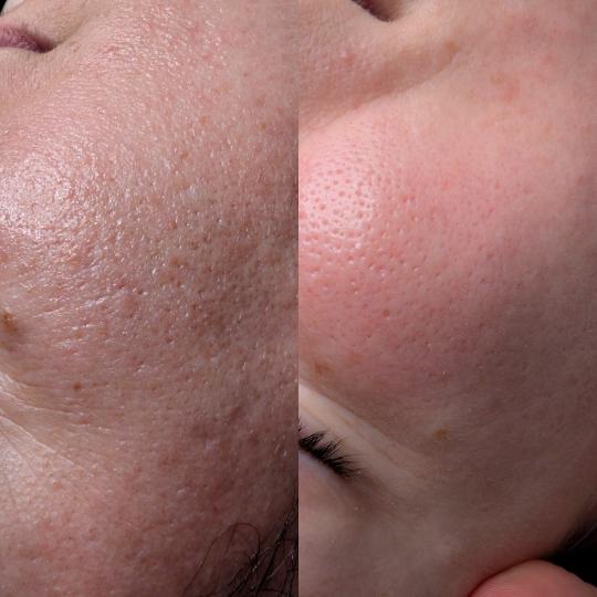 Brow & Glow #novisad Tretman lica Higijenski tretman lica