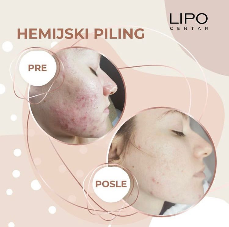 Hemijski piling - Lipo Centar, Beograd Tretman lica Lice Tretman lica, Beograd, Zvezdara