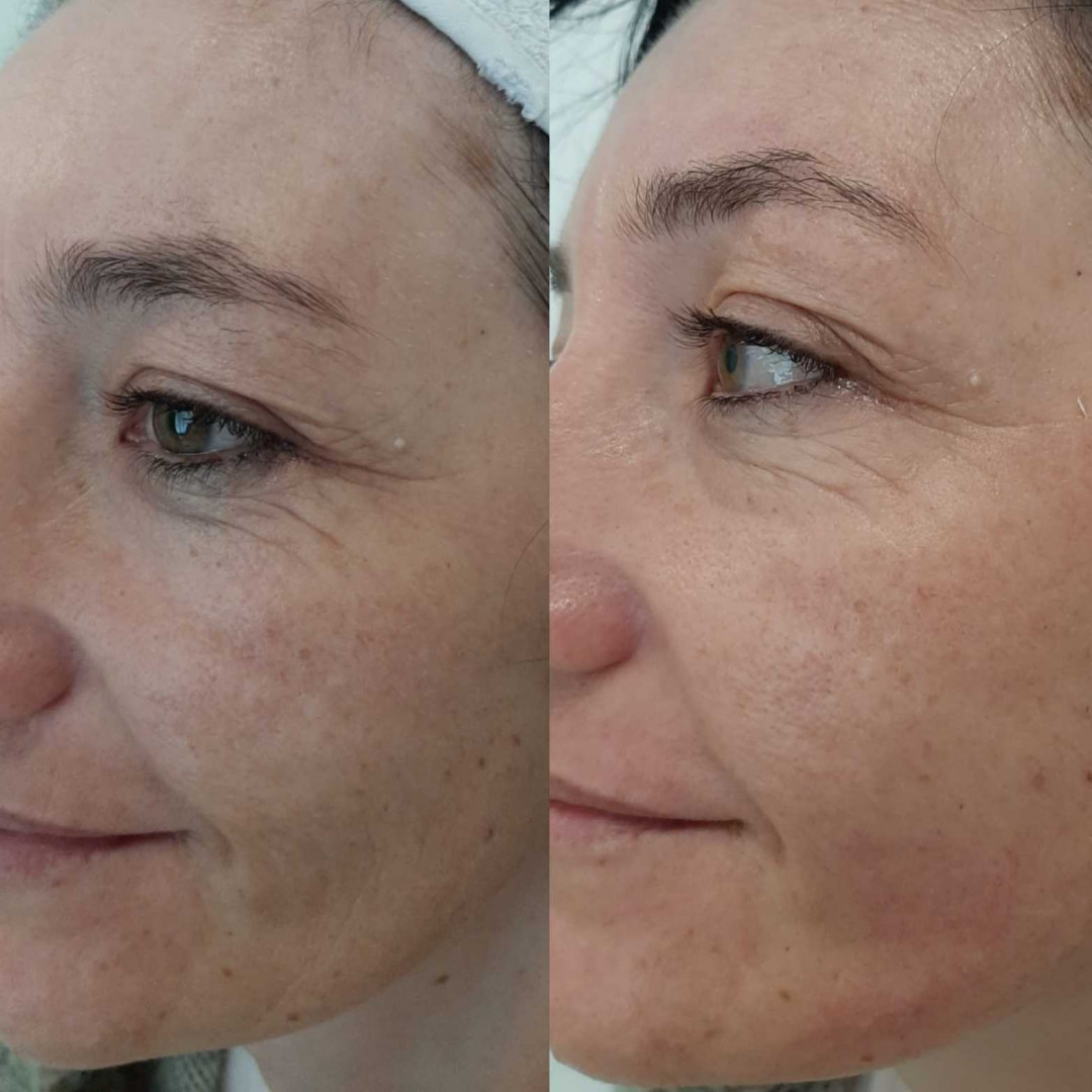 Olja Beauty #beograd Lifting / zatezanje kože HiFu tretman lica - po regiji