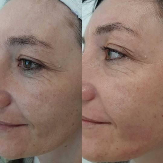 Olja Beauty #beograd Lifting / zatezanje kože HiFu tretman lica - po regiji 3D HIFU nehirusko zatez
