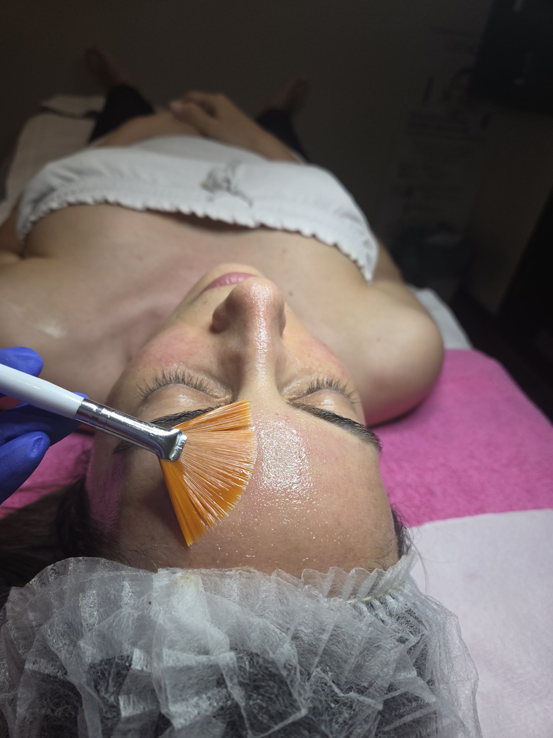 Starmedic #beograd Dermaroler i dermapen Holivudski sjaj - Jessner
