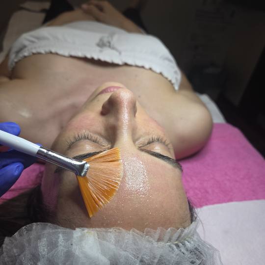 Starmedic #beograd Dermaroler i dermapen Holivudski sjaj - Jessner