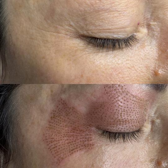 Manja pmu & beauty studio #pancevo Tretman lica Phi-Ion tretman - gornji kapci