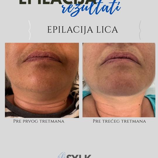 SYLK. Epilstudio Jagodina #jagodina Laserska epilacija Laserska epilacija celog lica - za dame