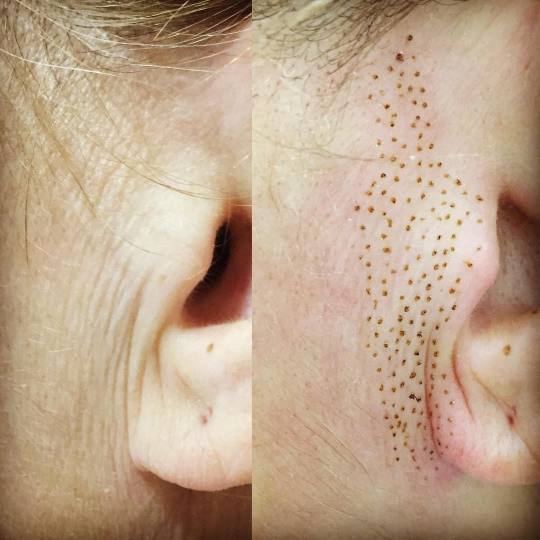 Ashanti Beauty Salon & Academy #beograd Tretman lica Plasma pen - koža oko ušiju