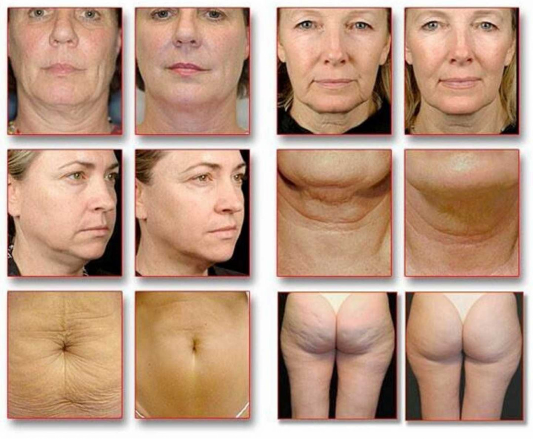 Grossi cosmetic #beograd Lifting / zatezanje kože