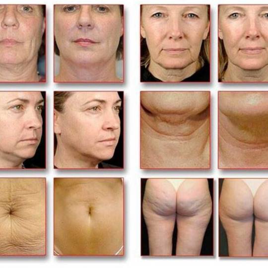Grossi cosmetic #beograd Lifting / zatezanje kože