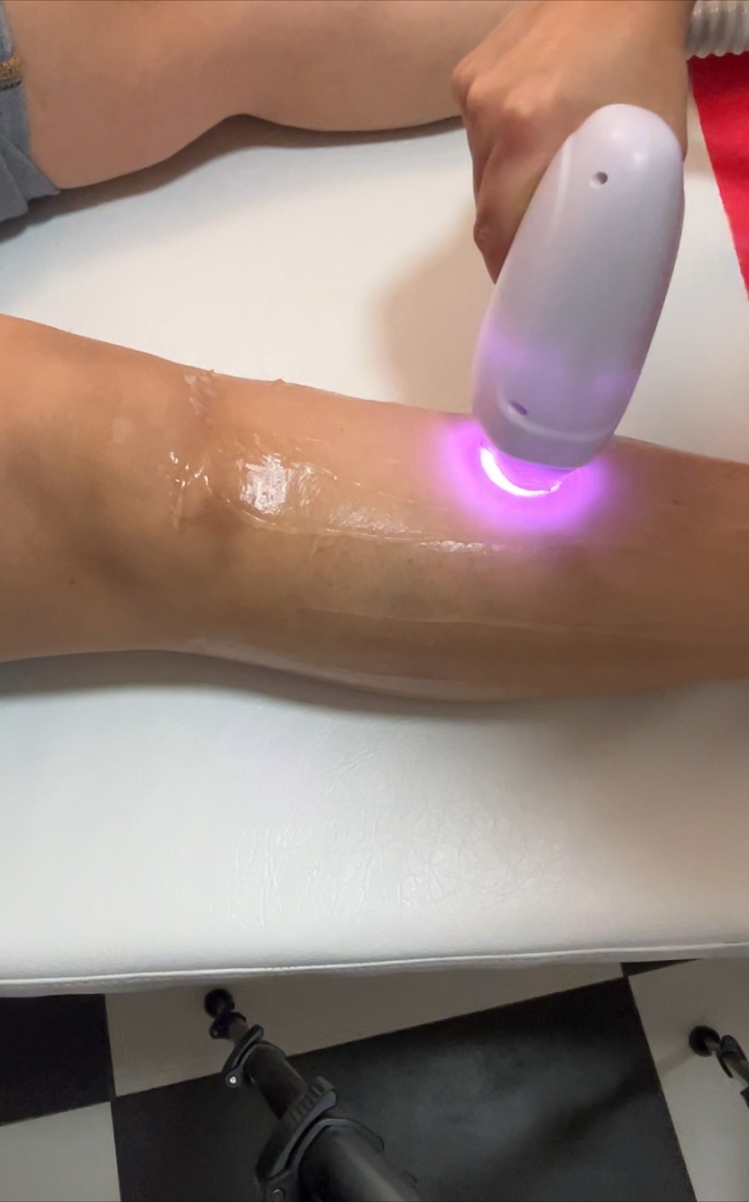 Odraz lepote #beograd Laserska epilacija Laserska epilacija potkolenica - za dame