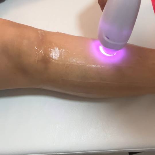 Odraz lepote #beograd Laserska epilacija Laserska epilacija potkolenica - za dame Професион