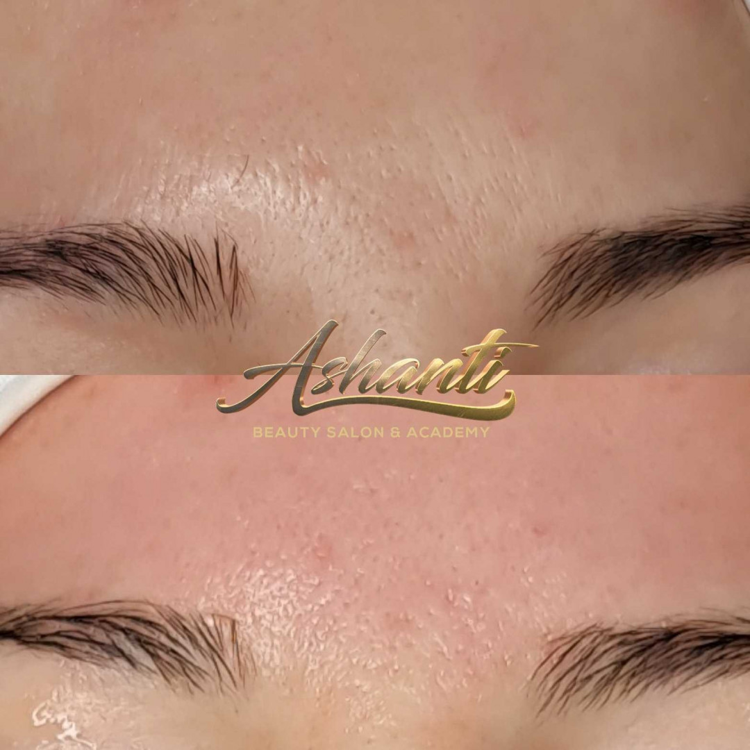 Ashanti Beauty Salon & Academy #beograd Dermaroler i dermapen PRP dermapen sa topikalnom anestezijom - celo lice