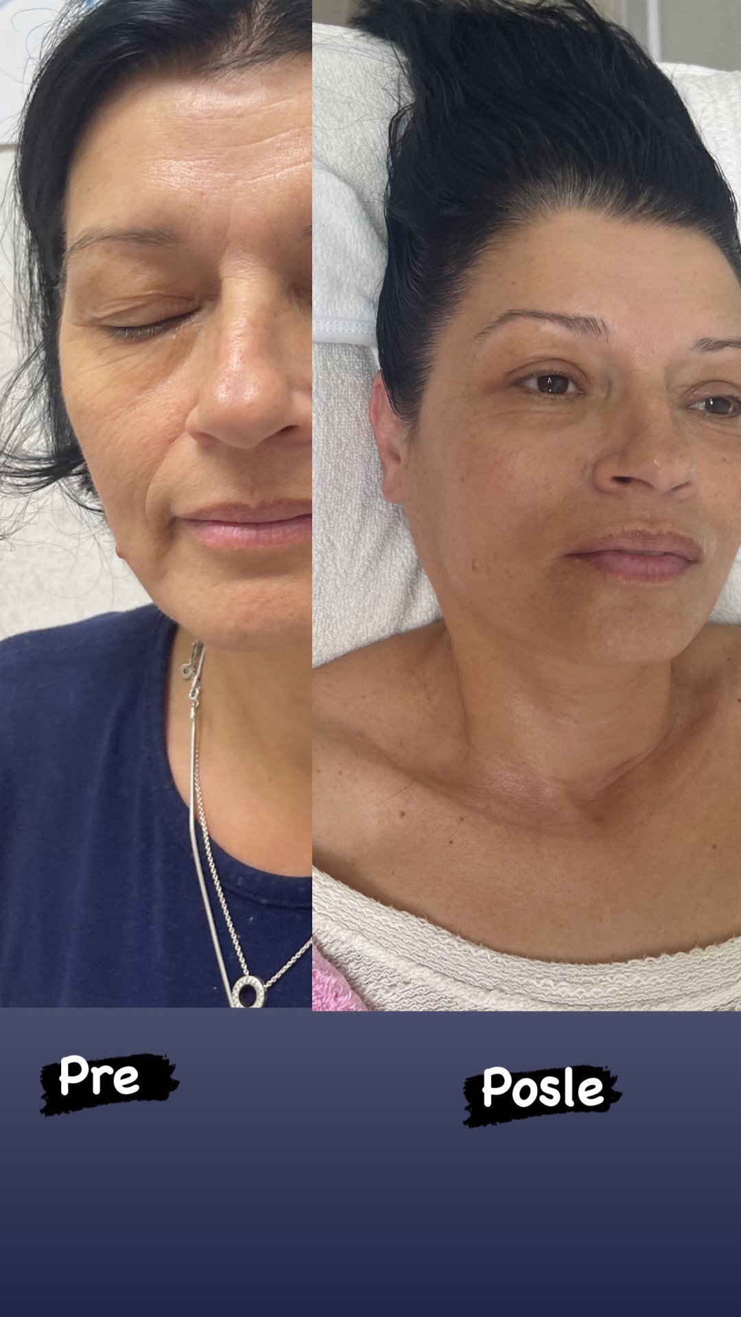 Make Up Jaca #beograd Tretman lica Radiotalasni lifting lica