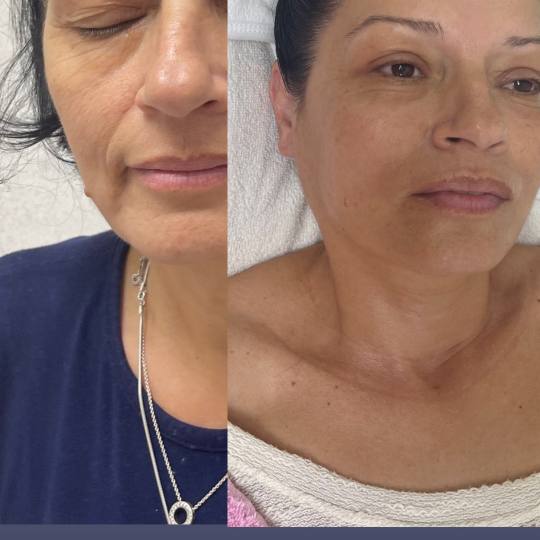 Make Up Jaca #beograd Tretman lica Radiotalasni lifting lica