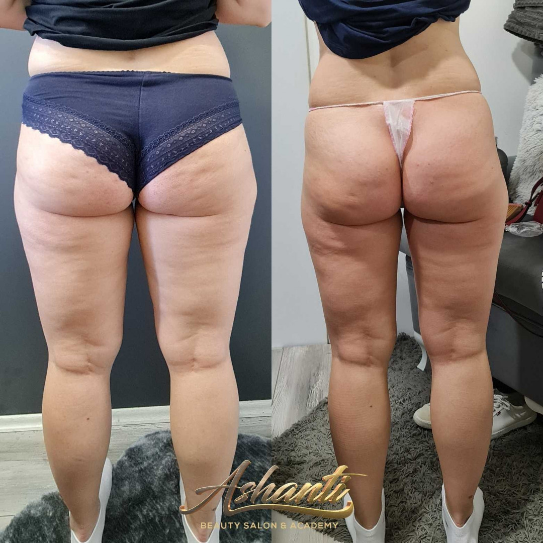 Ashanti Beauty Salon & Academy #beograd Masaža za mršavljenje Dermapen - regija lica