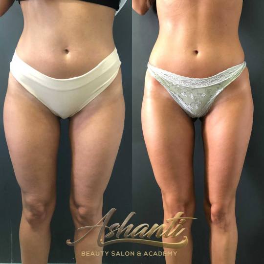 Ashanti Beauty Salon & Academy #beograd Anticelulit masaža 10 tretmana premium maderoterapije
