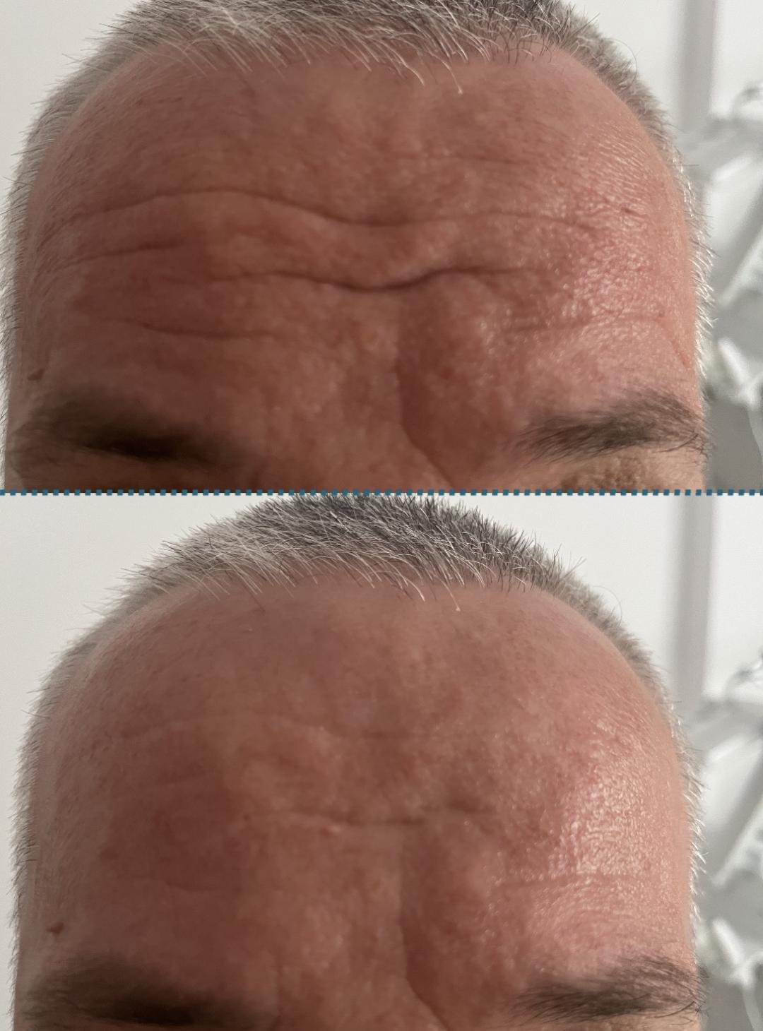 Amelini beauty concept #beograd Tretman lica Radiotalasni lifting lica