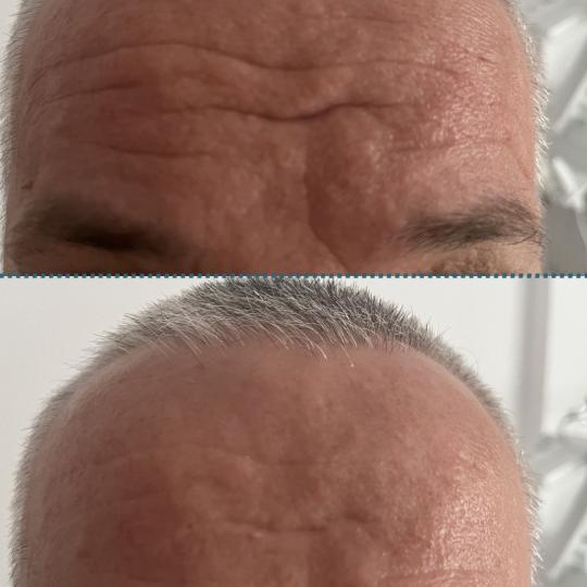 Amelini beauty concept #beograd Tretman lica Radiotalasni lifting lica ✨ Radiotalasni lifting lica