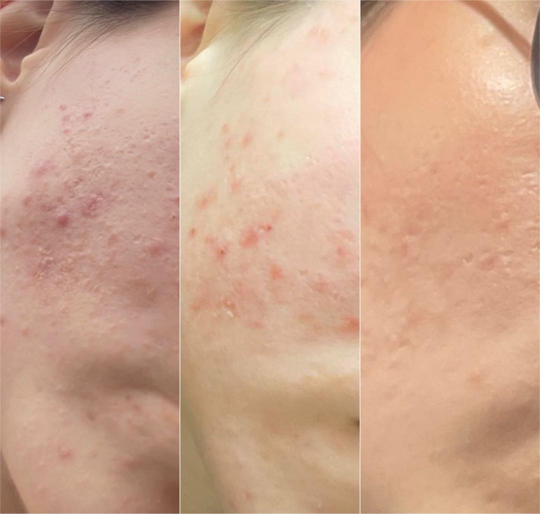 Look at me #beograd Tretman lica Acne delete