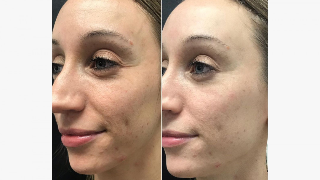 Salon Klinik #beograd Laserski tretmani lica Lasersko lečenje akni - kseno svetlo