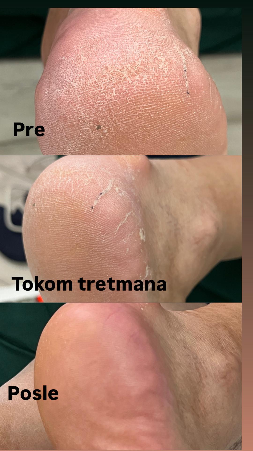 Belle Ana #beograd Estetski pedikir Ruski pedikir