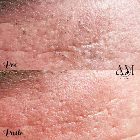 AM BEAUTY STUDIO #odzaci Tretman lica Higijenski tretman lica - problematična koža