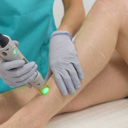 Ordinacija Epil Medic #beograd Laserska epilacija Laserska epilacija celih nogu - za dame Laserska e