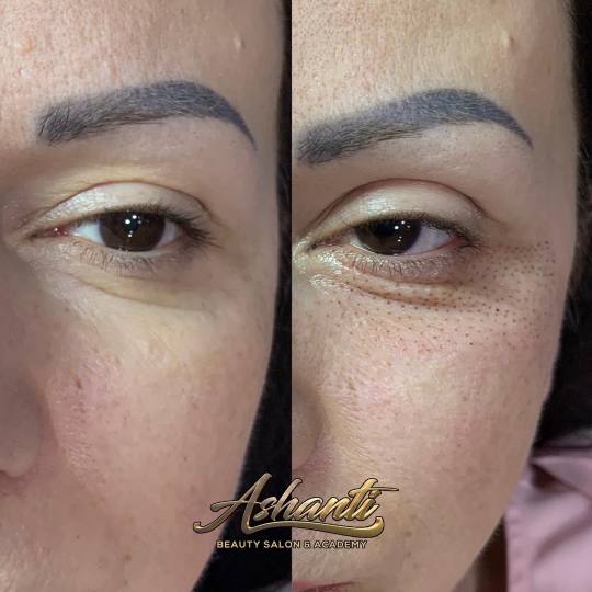 Ashanti Beauty Salon & Academy #beograd Tretman lica Plasma pen - podočnjaci