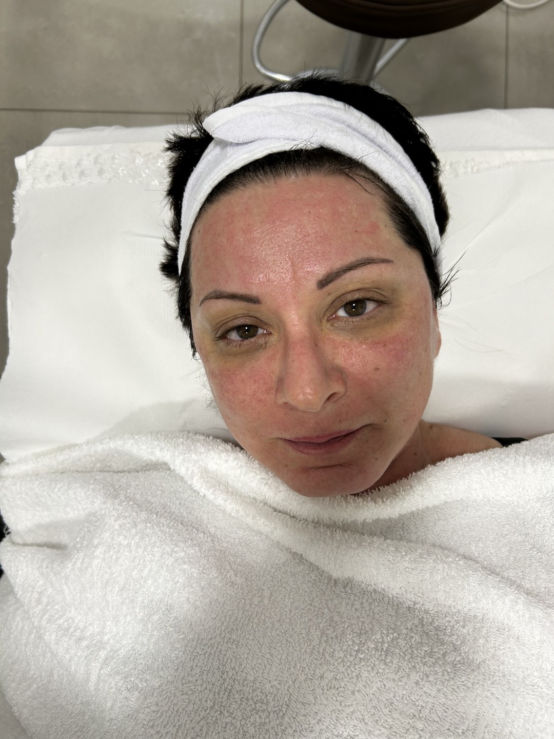 Sandra estetik studio #beograd Tretman lica Dermapen tretman lica