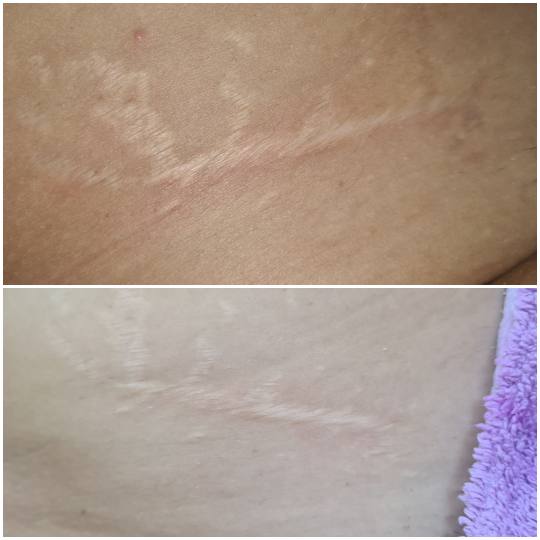 Laser centar Delight #beograd Tretmani tela Uklanjanje strija radiotalasima Uklanjanje strija Fraksa