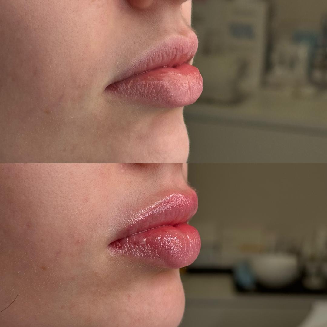 Hydralips-mezoterapija usana hijaluronom - L’Avenue, Beograd Mezoterapija lica Lice Mezoterapija lica, Beograd, Centar, Stari grad, Dorćol