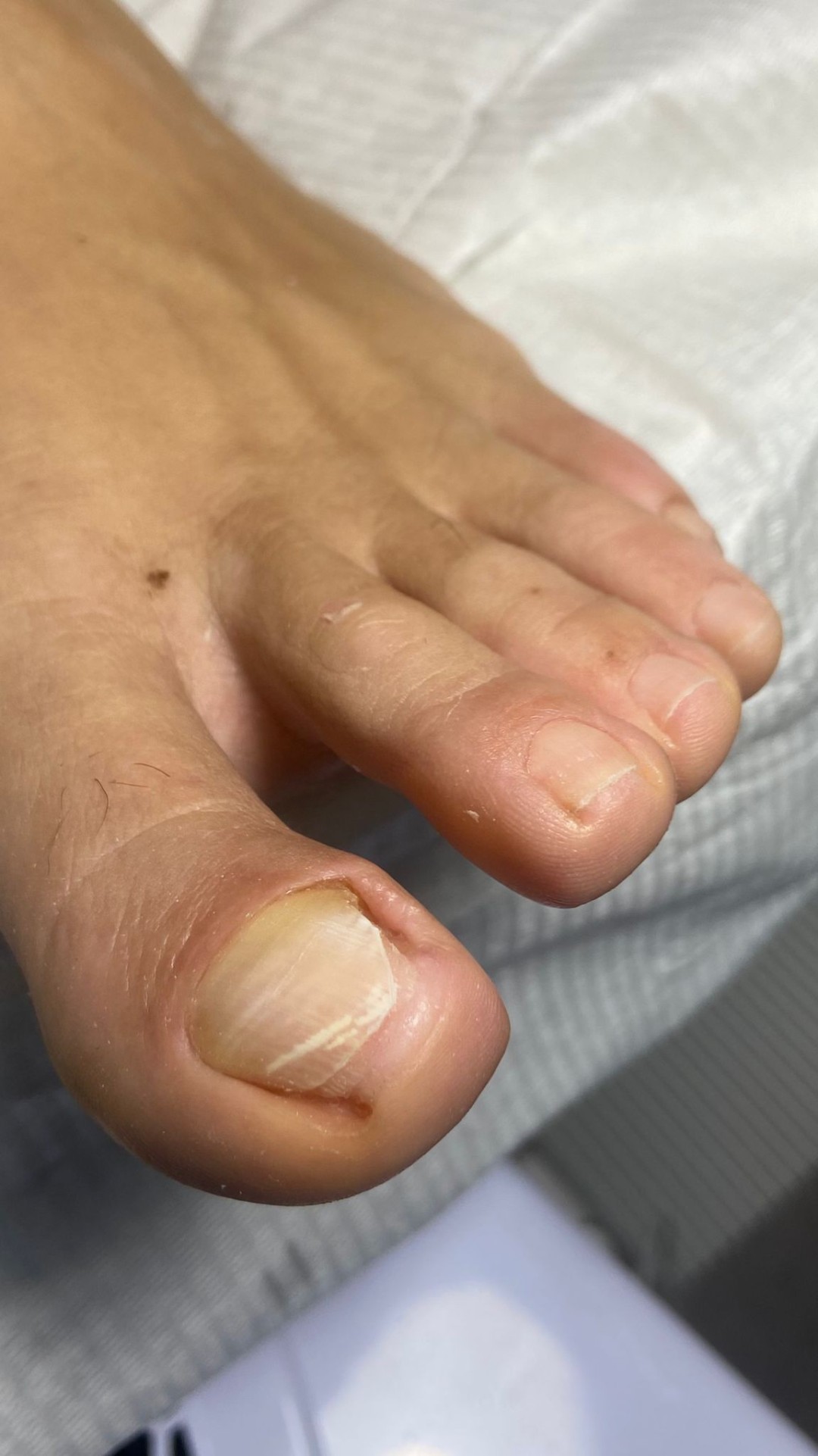 Touch Aesthetic&Medical care #beograd Medicinski pedikir Onohogripoza