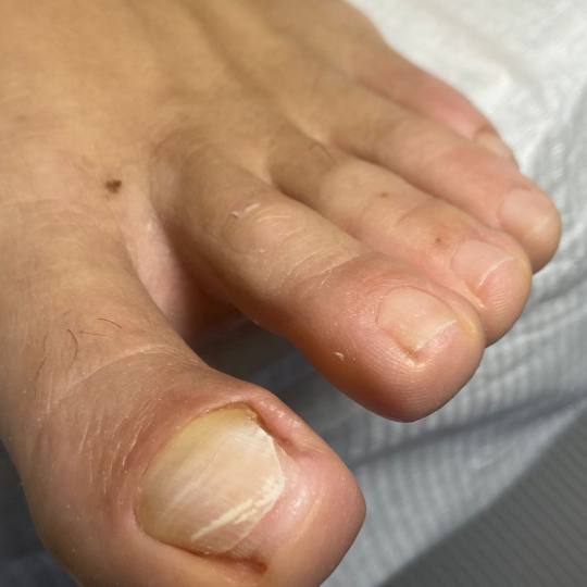 Touch Aesthetic&Medical care #beograd Medicinski pedikir Onohogripoza Medicinski pedikir